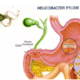 Urea Breath Test Helicobacter Pylori - Centri Diagnostici TBM a Roma